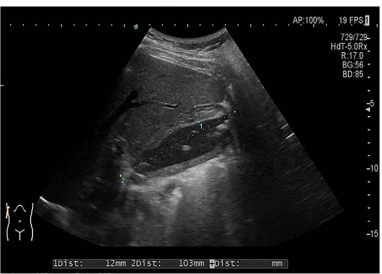 Abb. 1: Sonografisches Bild der akuten Cholezystitis mit typischer Wandverdickung und Dreischichtung